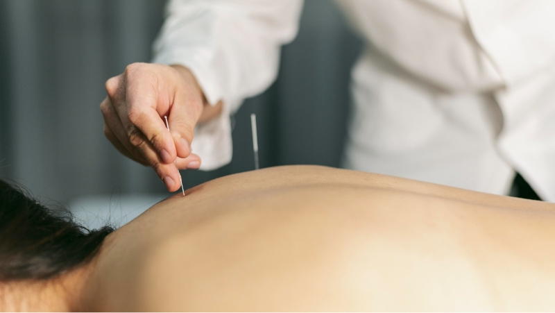 등에 침 치료중